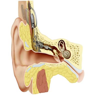 ear-implant
